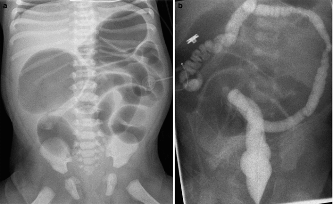 Pediatric Gastrointestinal Radiology