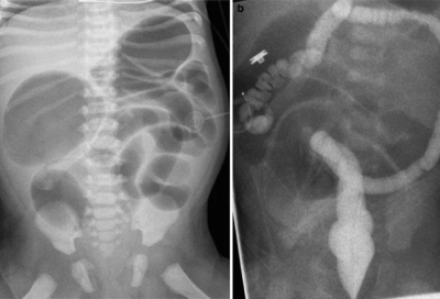 Pediatric Gastrointestinal Radiology